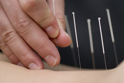 Quit smoking with acupuncture